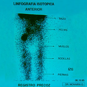 Linfografía dinámica o linfocentellografía