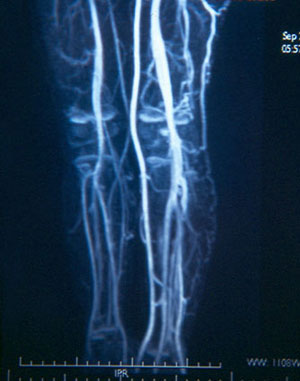 Angioresonancia con mayor irrigación en pierna izquierda